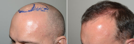 Hair Transplants for Men Before and after in Miami, FL, Paciente 127142