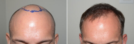 Hair Transplants for Men Before and after in Miami, FL, Paciente 127142