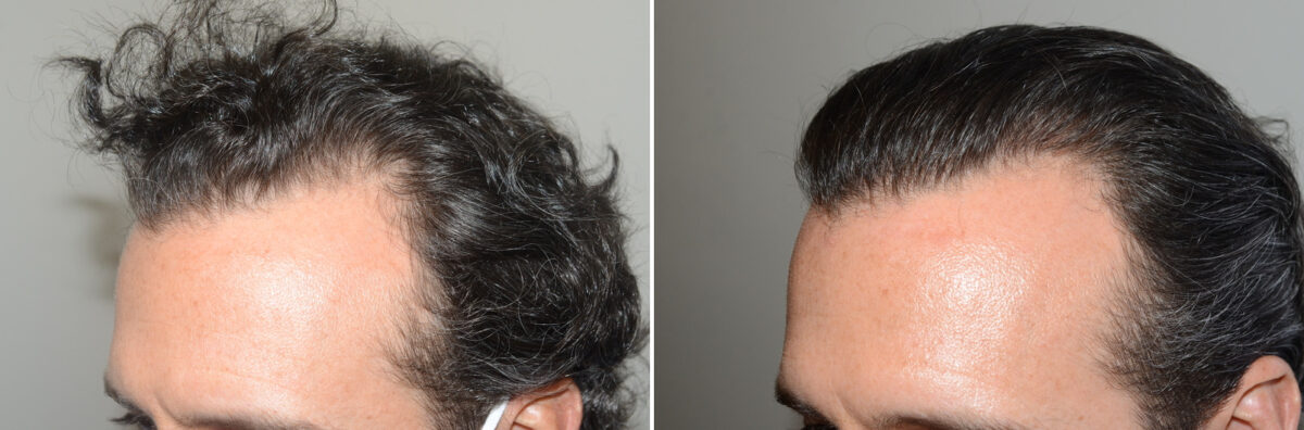 Hair Transplants for Men Before and after in Miami, FL, Paciente 127170