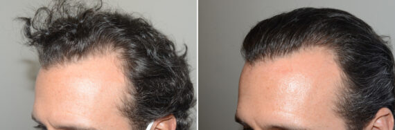 Hair Transplants for Men Before and after in Miami, FL, Paciente 127170