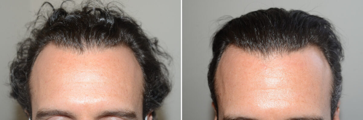 Hair Transplants for Men Before and after in Miami, FL, Paciente 127170