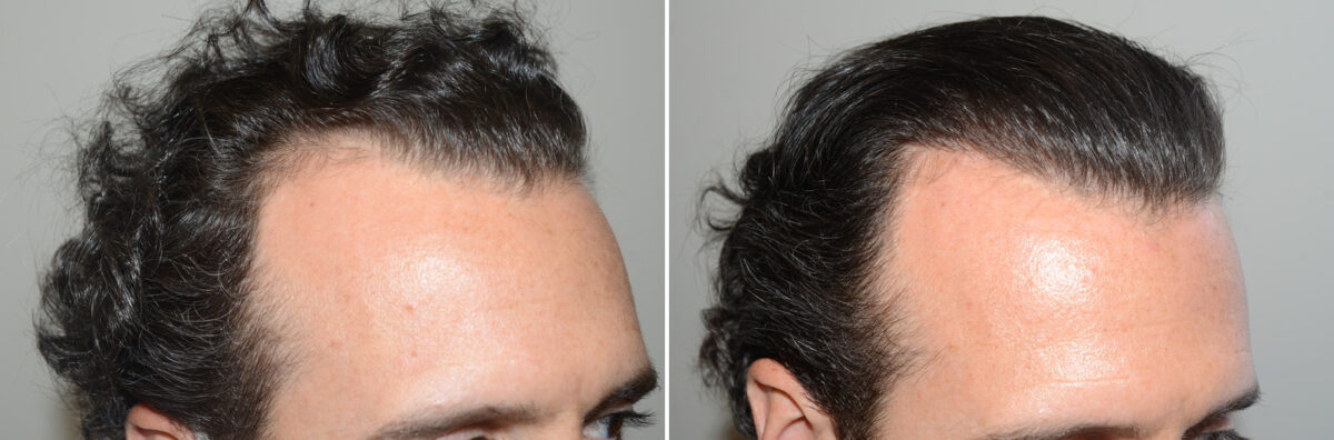 Hair Transplants for Men Before and after in Miami, FL, Paciente 127170