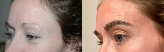 Eyebrow Hair Transplant Before and after in Miami, FL, Paciente 127195