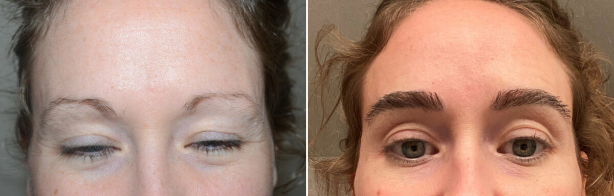 Eyebrow Hair Transplant Before and after in Miami, FL, Paciente 127195