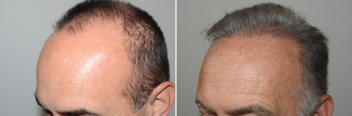 Hair Transplants for Men Before and after in Miami, FL, Paciente 127220