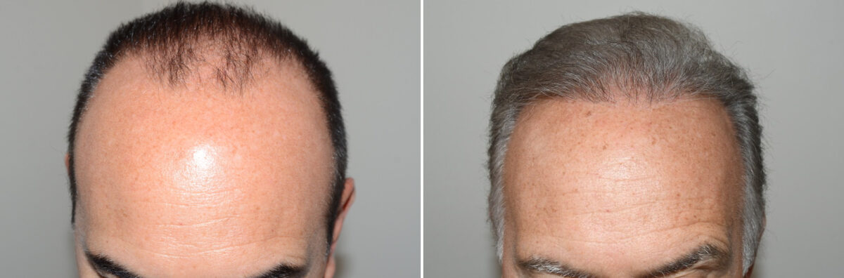 Hair Transplants for Men Before and after in Miami, FL, Paciente 127220