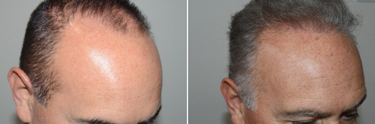 Hair Transplants for Men Before and after in Miami, FL, Paciente 127220