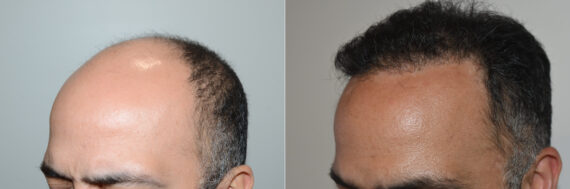 Hair Transplants for Men Before and after in Miami, FL, Paciente 127242
