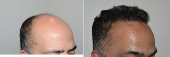 Hair Transplants for Men Before and after in Miami, FL, Paciente 127242