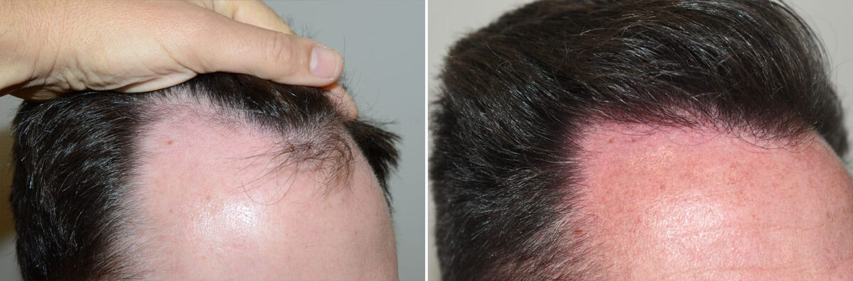 Hair Transplants for Men Before and after in Miami, FL, Paciente 127304