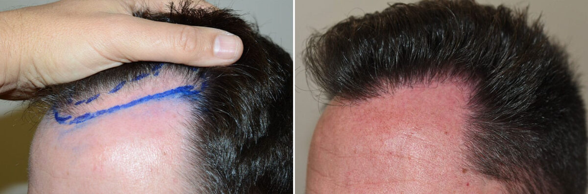 Hair Transplants for Men Before and after in Miami, FL, Paciente 127304