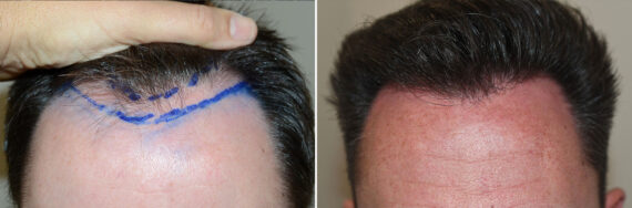 Hair Transplants for Men Before and after in Miami, FL, Paciente 127304