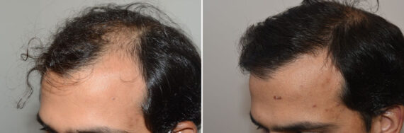 Hair Transplants for Men Before and after in Miami, FL, Paciente 127325