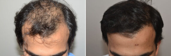 Hair Transplants for Men Before and after in Miami, FL, Paciente 127325