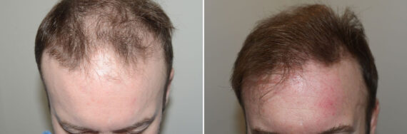 Body Hair Transplant Before and after in Miami, FL, Paciente 127339