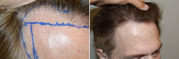 Hair Transplants for Men Before and after in Miami, FL, Paciente 127355