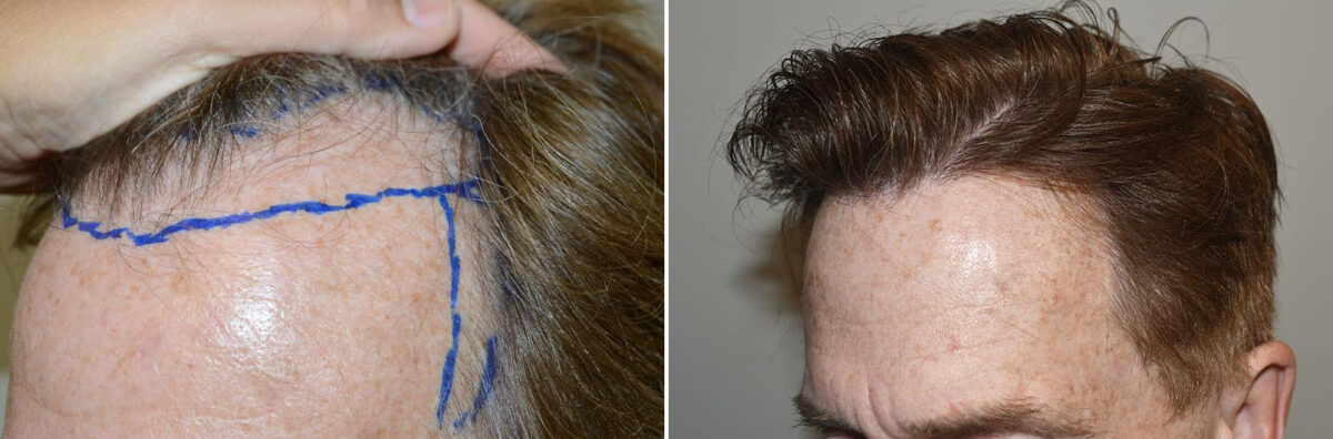 Hair Transplants for Men Before and after in Miami, FL, Paciente 127355