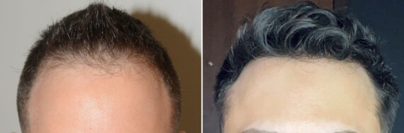 Forehead Reduction Surgery Before and after in Miami, FL, Paciente 127374