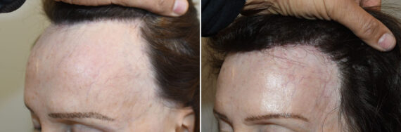 Forehead Reduction Surgery Before and after in Miami, FL, Paciente 127381