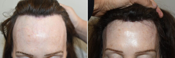 Forehead Reduction Surgery Before and after in Miami, FL, Paciente 127381