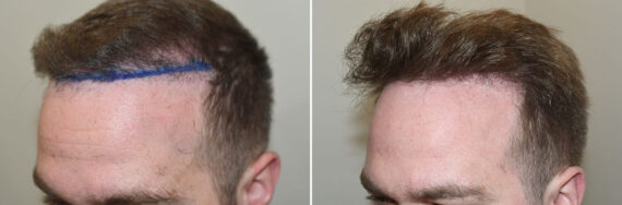 Hair Transplants for Men Before and after in Miami, FL, Paciente 127394
