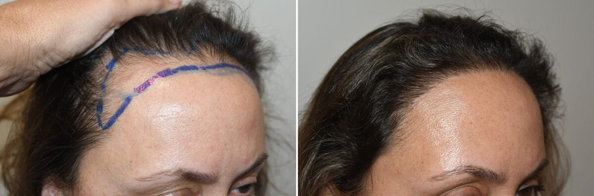 Hair Transplants for Women Before and after in Miami, FL, Paciente 127401