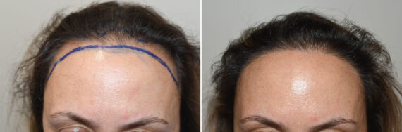 Hair Transplants for Women Before and after in Miami, FL, Paciente 127401