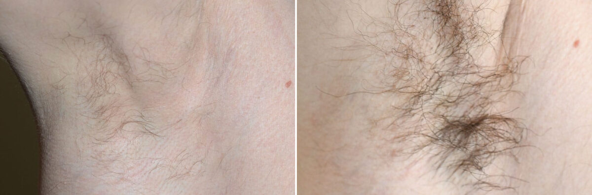 Body Hair Transplant Before and after in Miami, FL, Paciente 127420