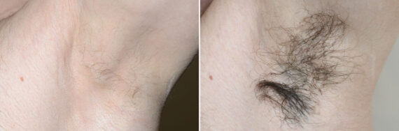 Body Hair Transplant Before and after in Miami, FL, Paciente 127420