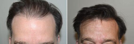 Body Hair Transplant Before and after in Miami, FL, Paciente 127433