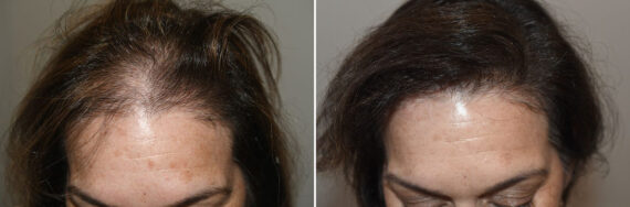 Hair Transplants for Women Before and after in Miami, FL, Paciente 127446