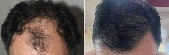 Hair Transplants for Men Before and after in Miami, FL, Paciente 127453