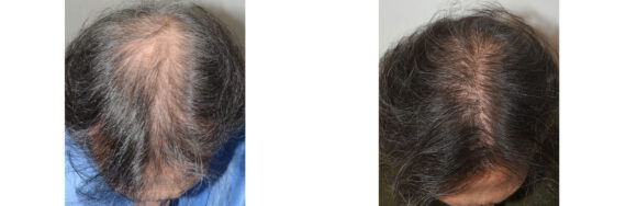 Hair Transplants for Men Before and after in Miami, FL, Paciente 127460