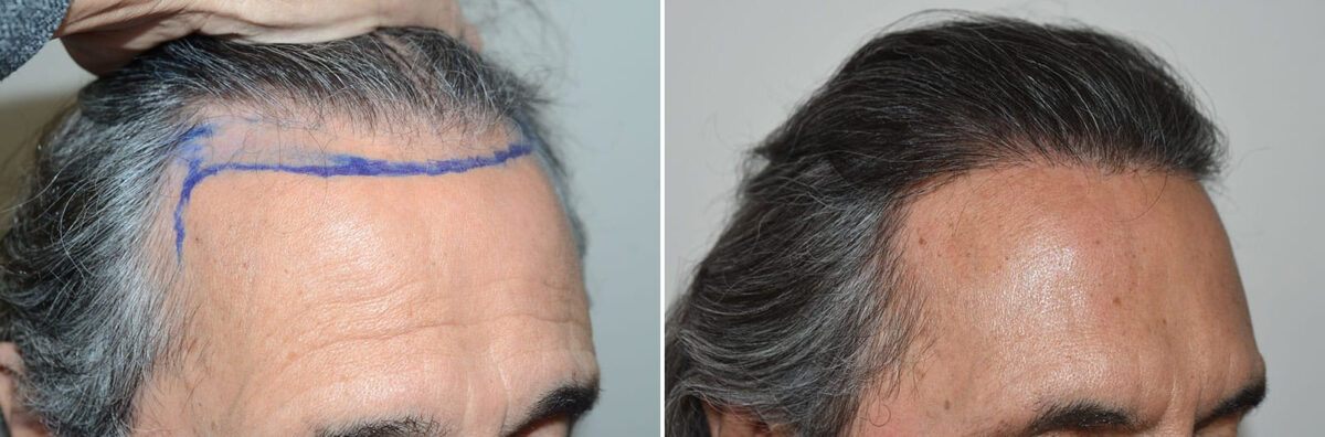 Hair Transplants for Men Before and after in Miami, FL, Paciente 127460