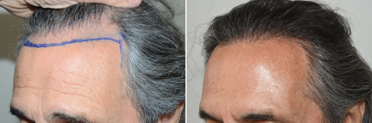 Hair Transplants for Men Before and after in Miami, FL, Paciente 127460