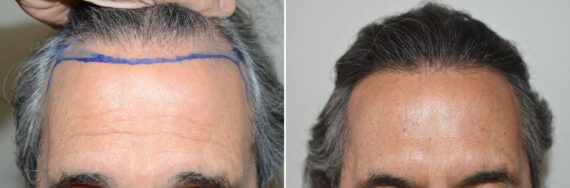 Hair Transplants for Men Before and after in Miami, FL, Paciente 127460