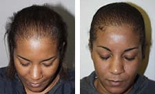 African Hair Loss | Miami | New York