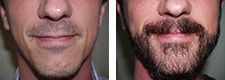 Facial Hair Transplant | Beard Trasplant | Miami, FL | New York, NY